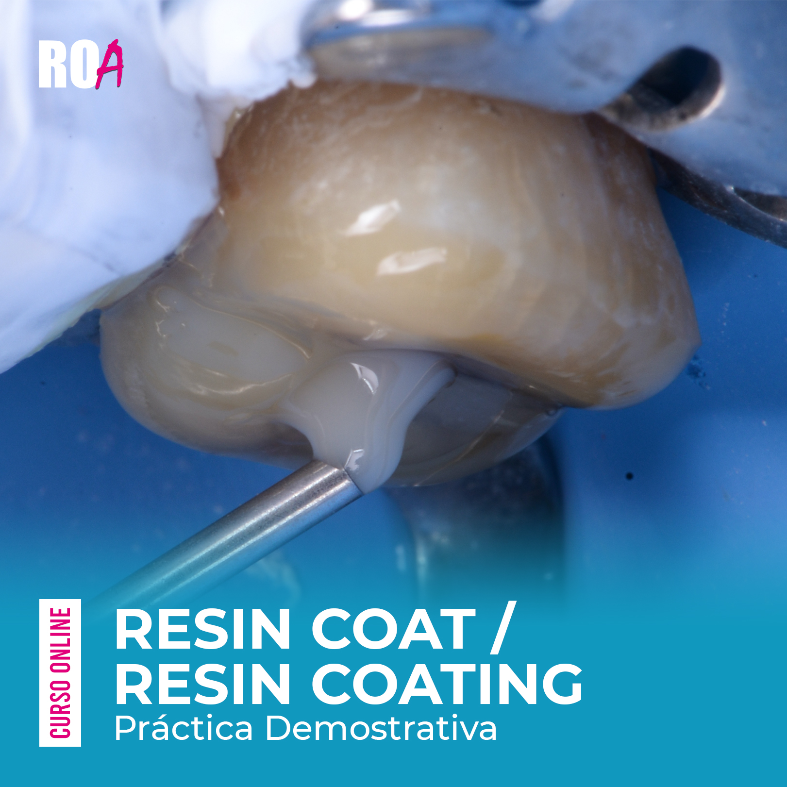 Resin Coat / Resin Coating – Práctica Demostrativa.