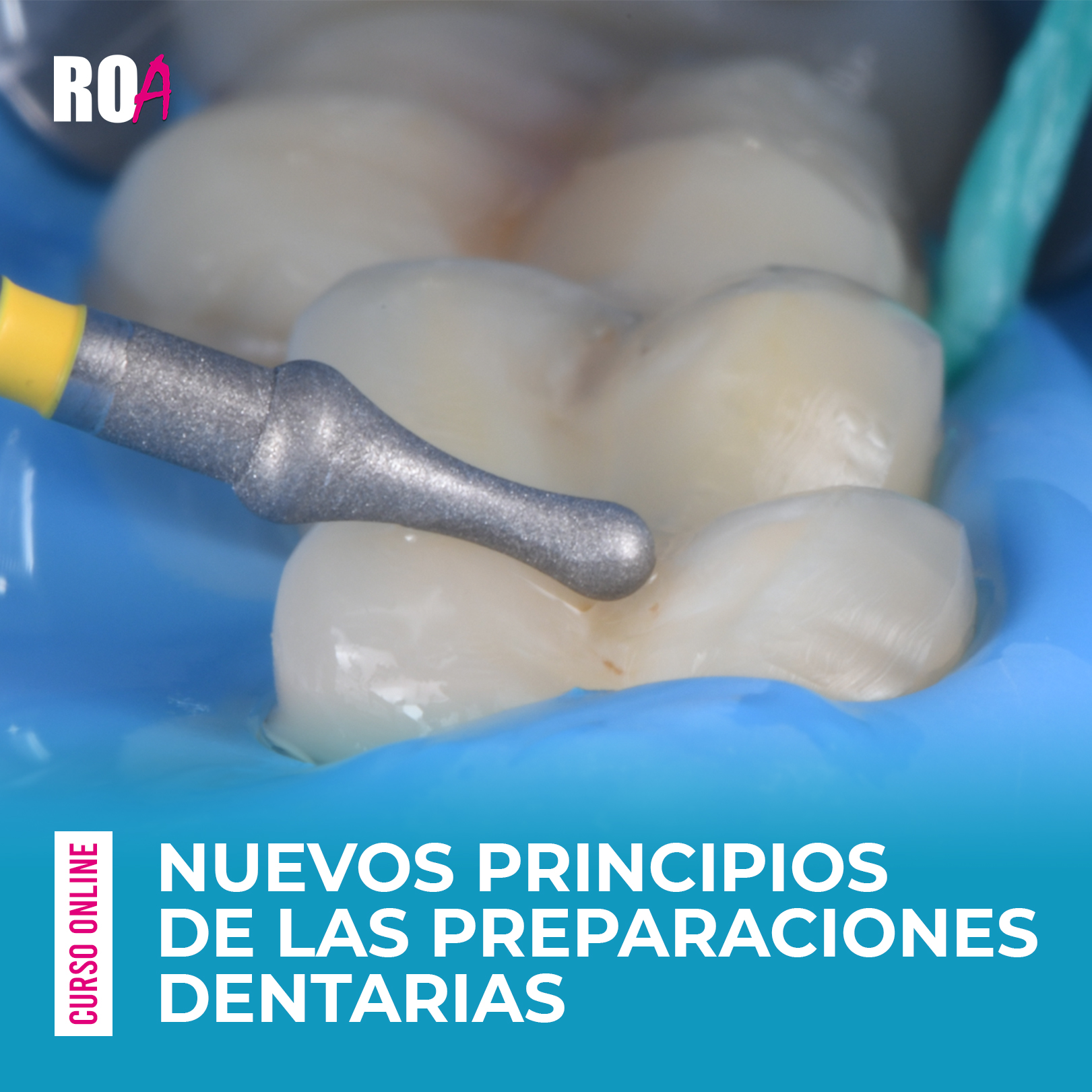 Nuevos Principios de las Preparaciones Dentarias .